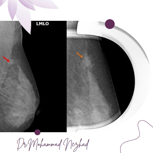 کاربرد mammography با بزرگنمایی