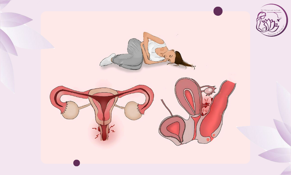 Endometriosis Mapping سونوگرافی چیست؟