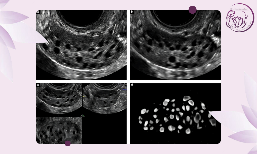 کاربردهای سونو شمارش Antral follicle