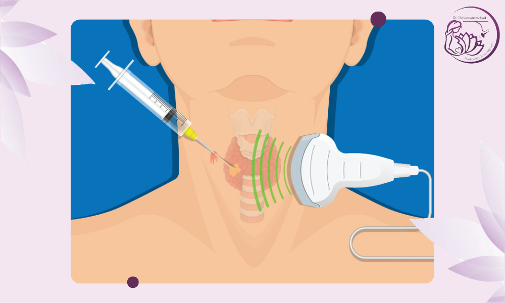 مروری بر FNA تیروئید