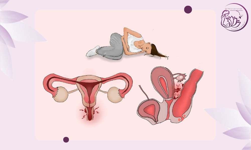Endometriosis Mapping سونوگرافی چیست؟ Endometriosis Mapping سونوگرافی چیست؟