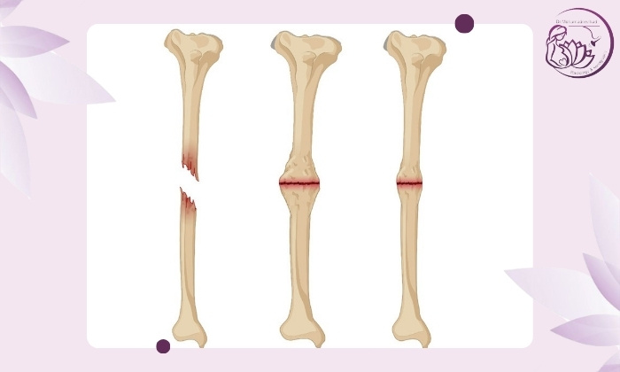 نشانه‌های استخوان جوش نخورده