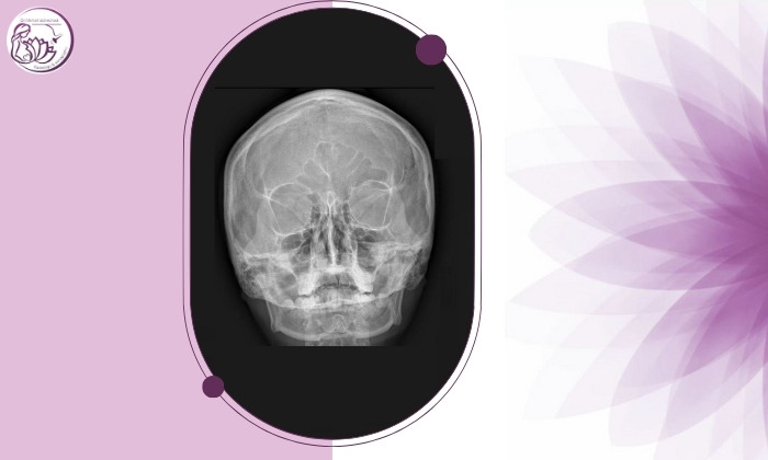 آیا عکس ساده سینوس‌ها در تشخیص سینوزیت دقیق است؟