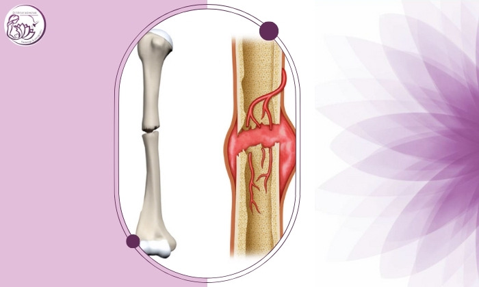 استخوان جوش نخورده چه نشانه‌هایی دارد و چرا تشخیص آن مهم است؟