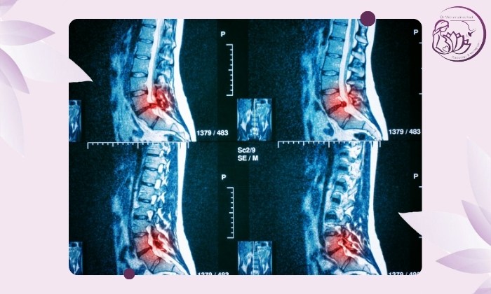 بررسی کمردرد با رادیولوژی و MRI