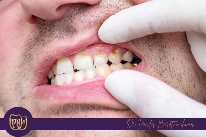 تأثیرات خوابیدن با دهان باز بر دندان‌ ها