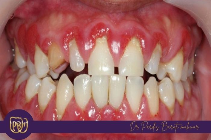 تأثیرات خوابیدن با دهان باز بر لثه‌ها و بافت ‌های نرم