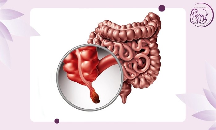 تشخیص التهاب آپاندیس با سونوگرافی