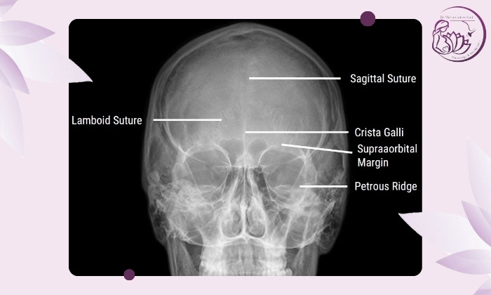 تشخیص سینوزیت با عکس ساده سینوس‌ها