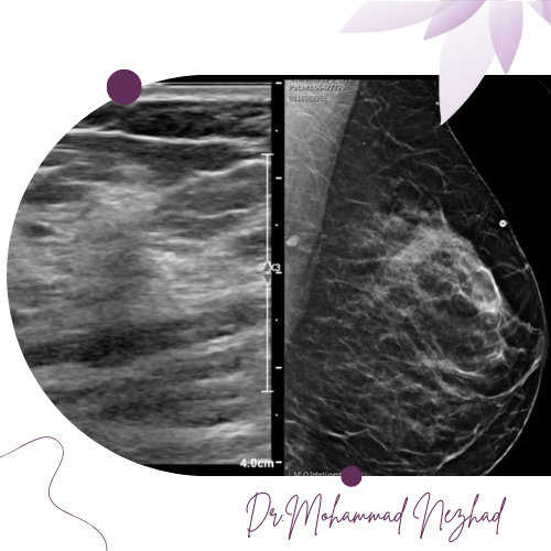 تفاوت ماموگرافی و سونوگرافی پستان