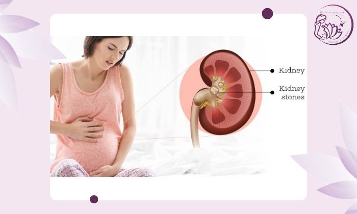 علائم سنگ کلیه در بارداری