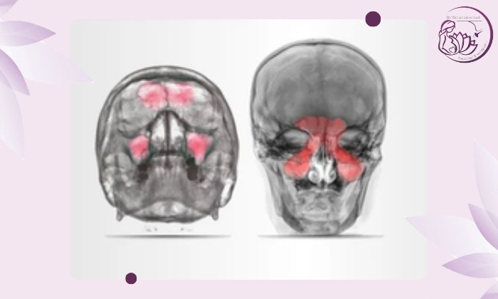 مزایا و معایب عکس ساده سینوس‌ها
